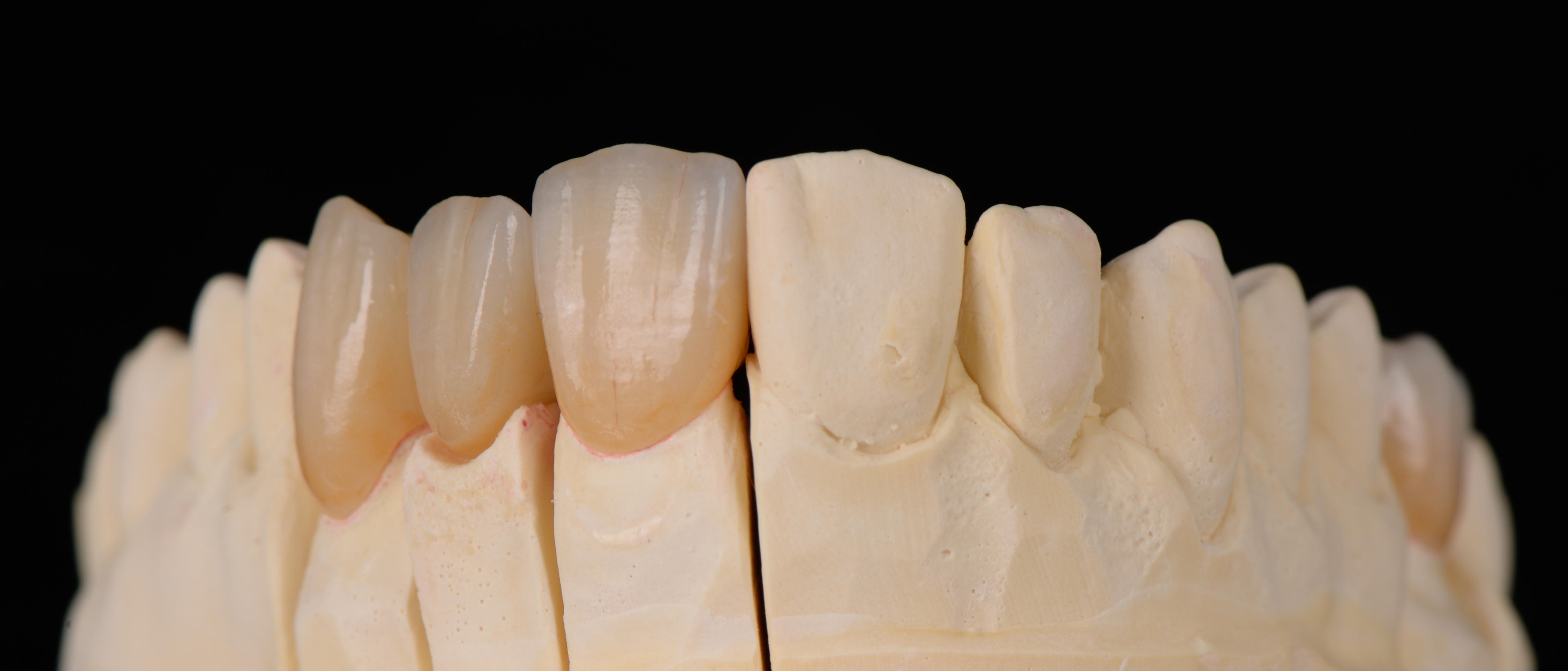 Zirconia Crown & Bridge