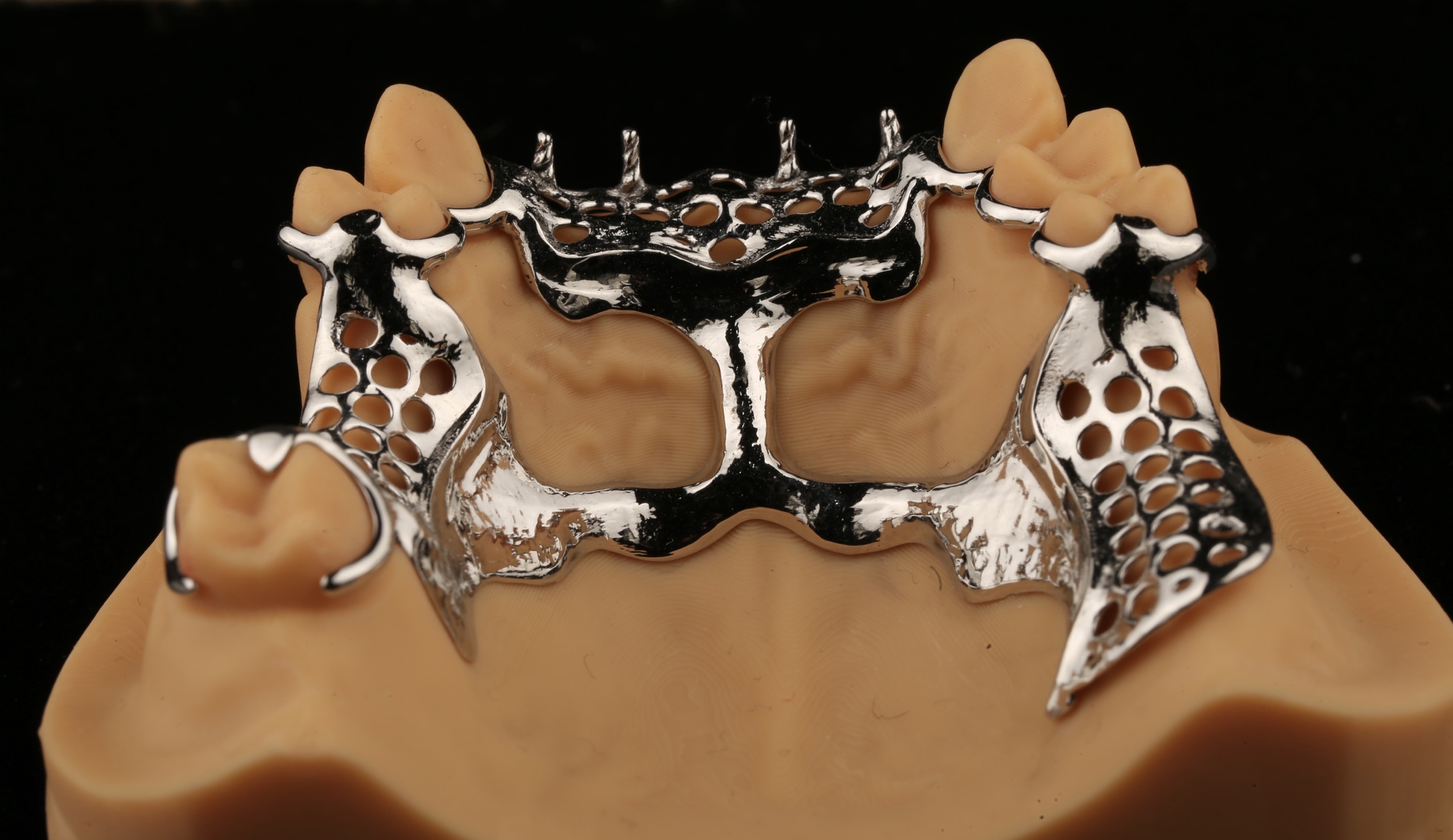 Cast Metal Partial Denture