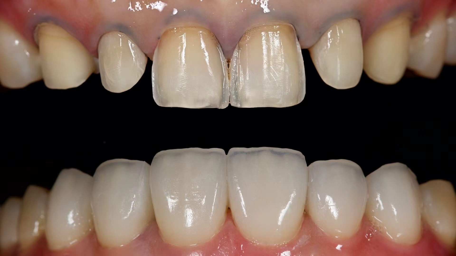 Porcelain Veneers