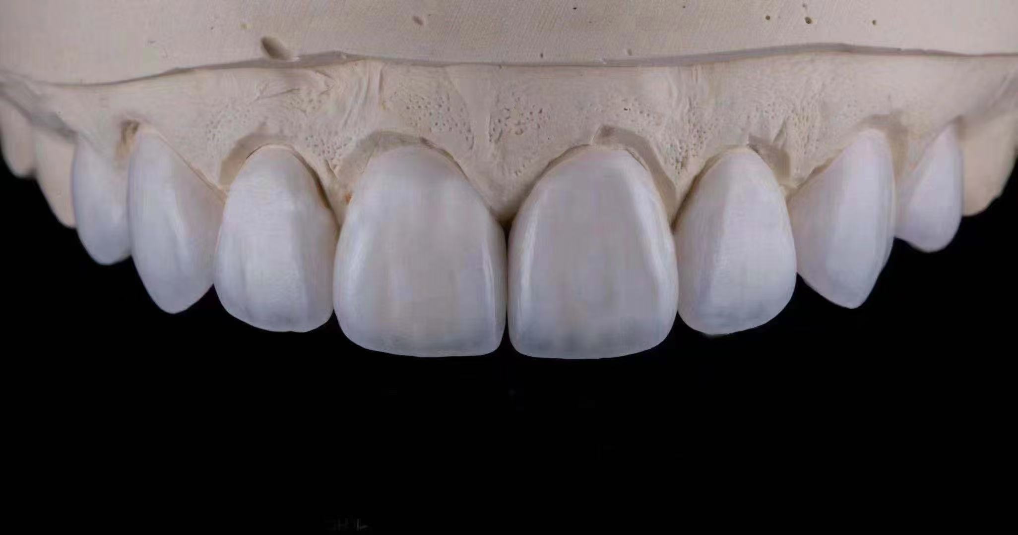 Porcelain Veneers
