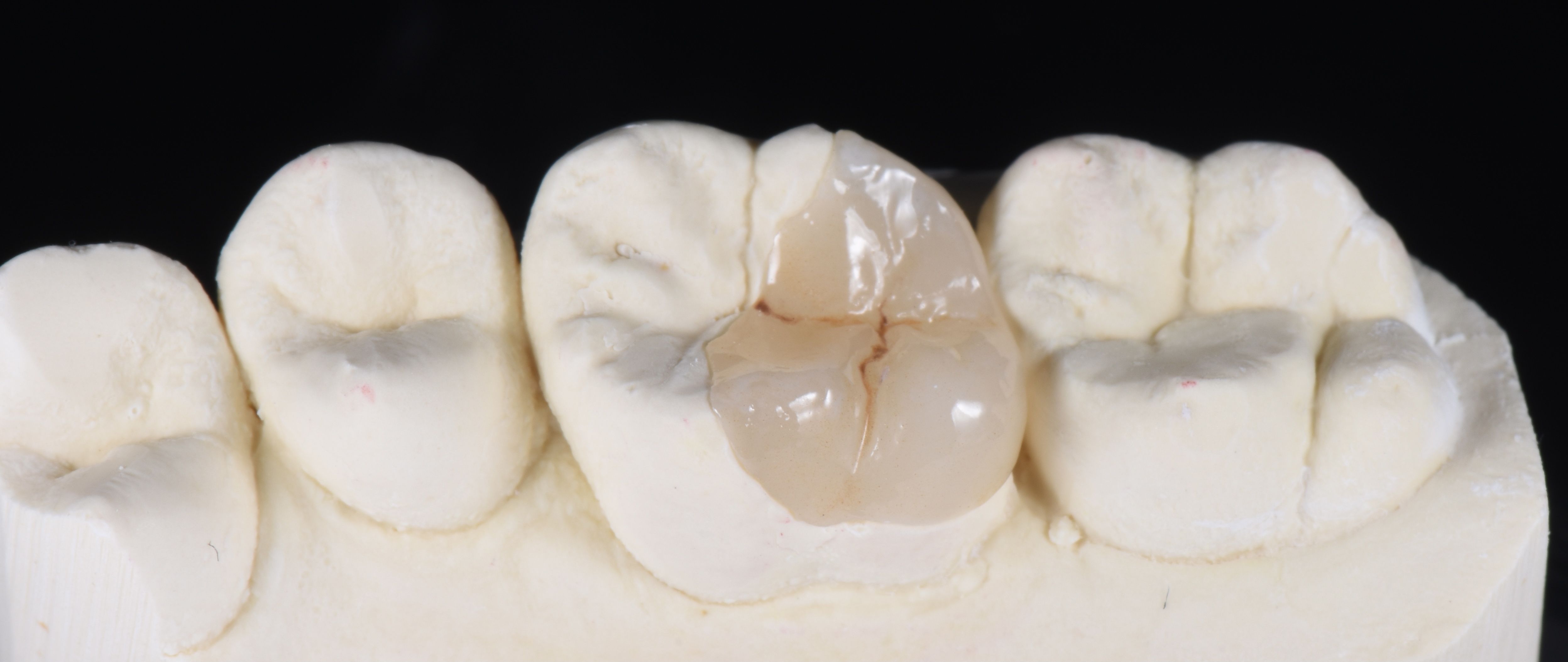 Dental Inlay & Onlay