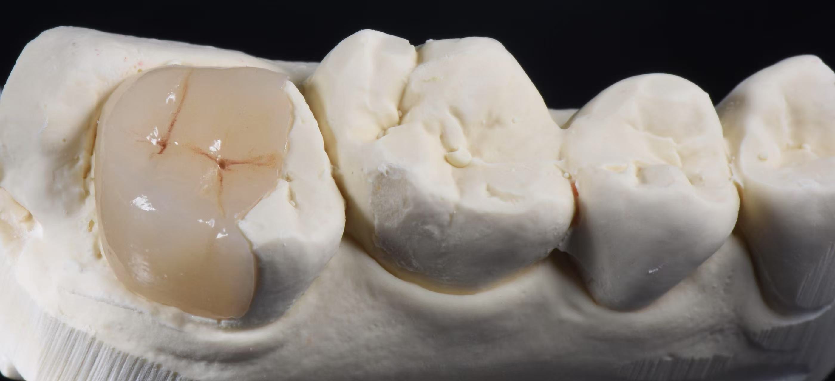 Dental Inlay & Onlay